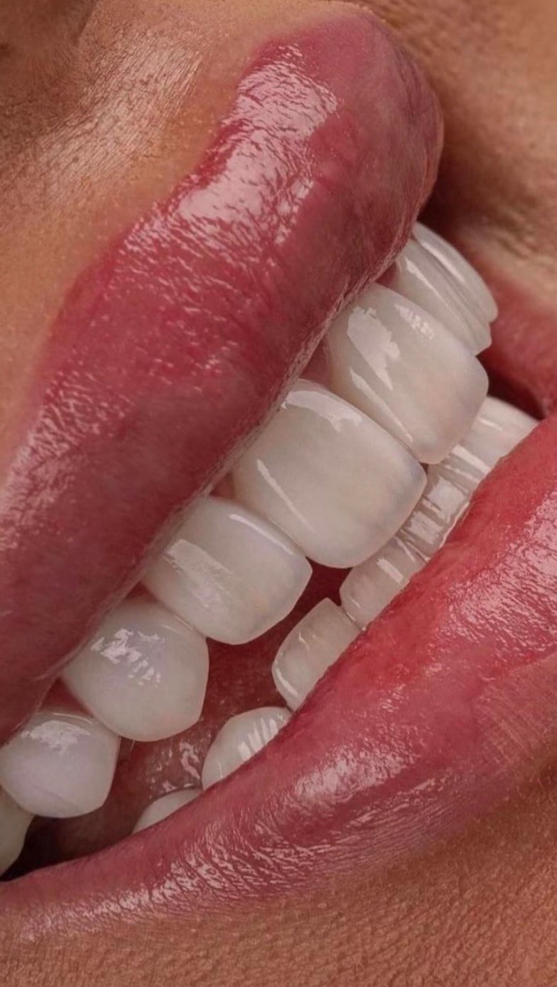 Teeth Whitening Care Tips